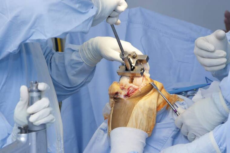 chirurgia dell'artrosi del ginocchio