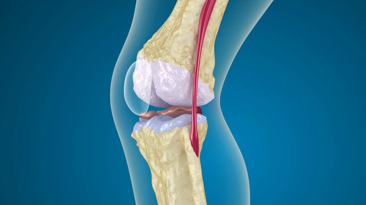 distruzione dell'articolazione del ginocchio con artrosi