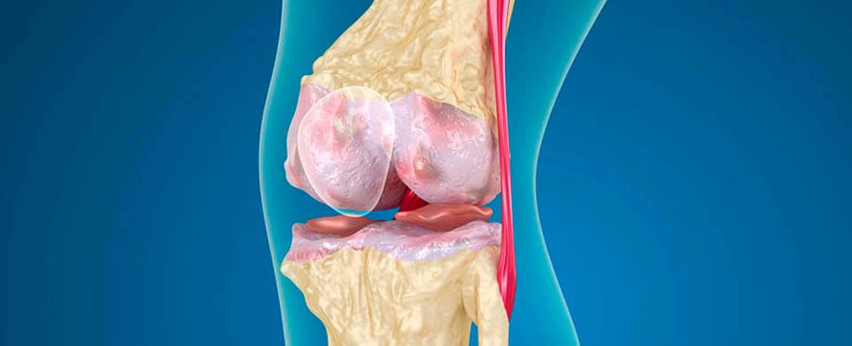 artrosi del ginocchio come causa di dolore