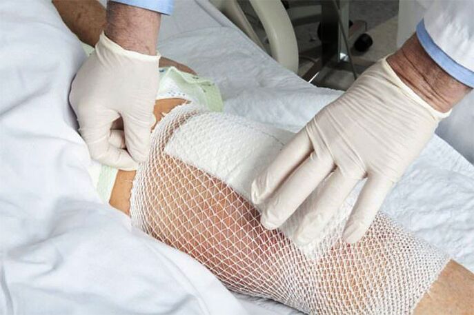 Impacco terapeutico per l'artrosi dell'articolazione del ginocchio