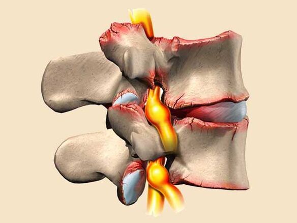 lesione spinale nell'osteocondrosi toracica