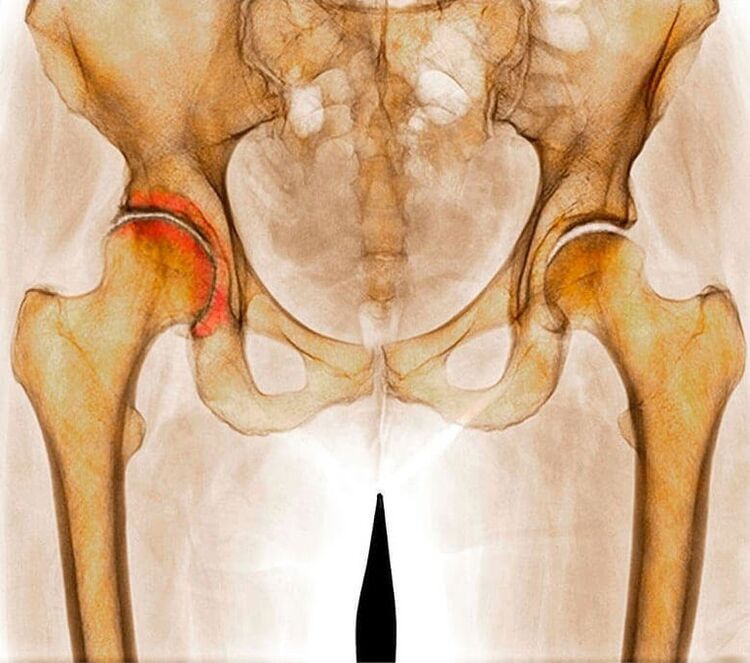 infiammazione dell'articolazione dell'anca come causa di dolore
