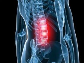 Osteocondrosi della colonna lombare