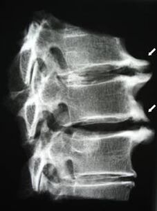 Gli osteofiti del rachide cervicale causano dolore al collo
