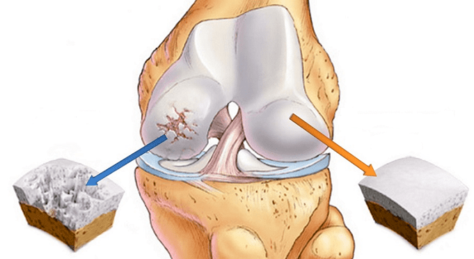 cartilagine sana e cartilagine affetta da artrosi
