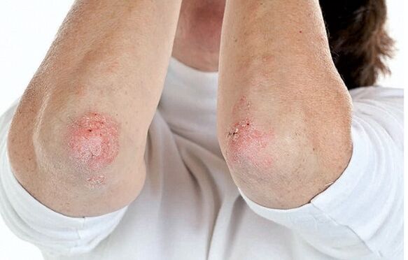 Le persone con psoriasi sono suscettibili all’artrite psoriasica