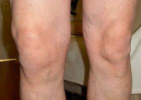 sintomi al ginocchio