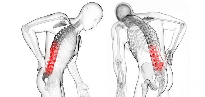complicanze con osteocondrosi cervicale