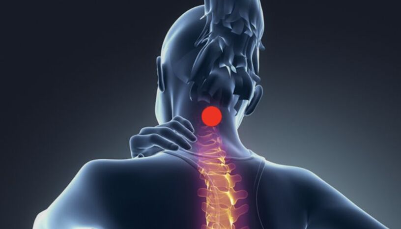 sintomi dell'osteocondrosi cervicale
