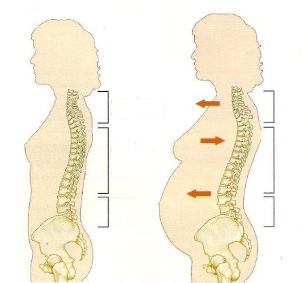 osteocondrosi durante la gravidanza