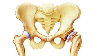 perché si verifica l'artrosi dell'articolazione dell'anca
